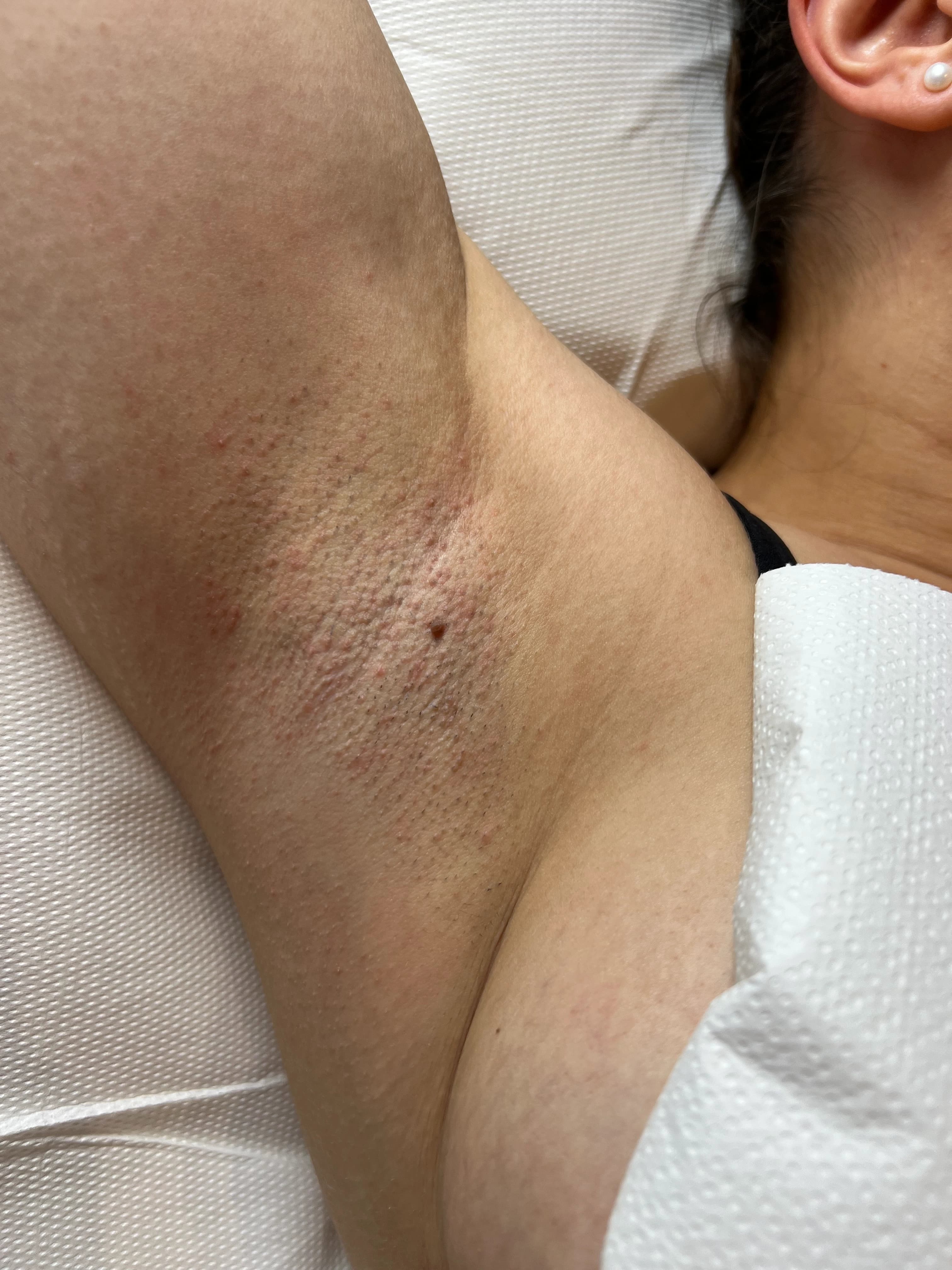 Before Treatment